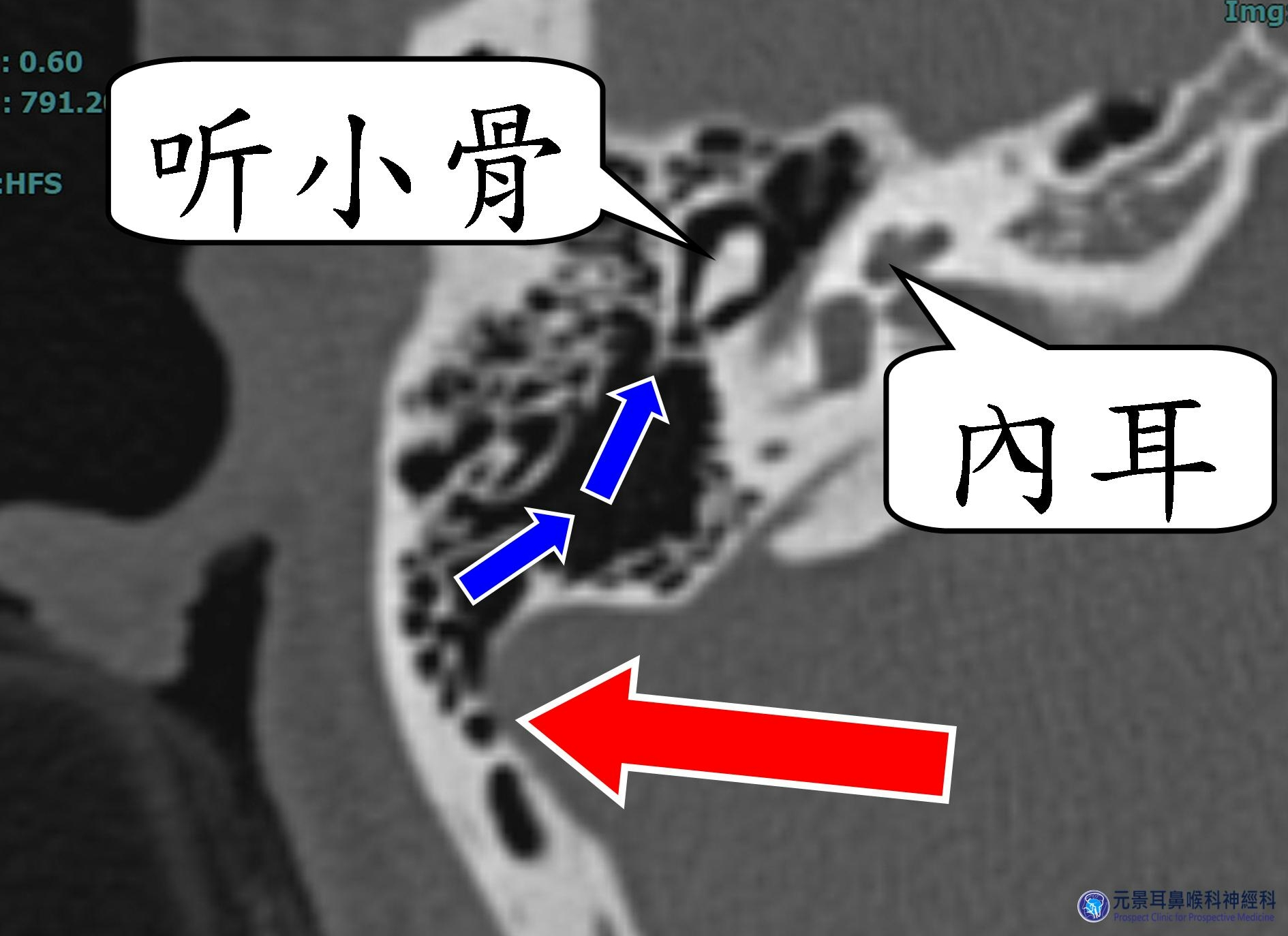 台湾耳鸣名医：女性感冒后出现搏动性耳鸣，诊断为大脑静脉窦异常